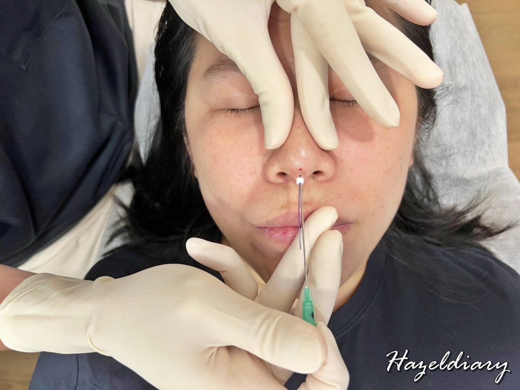 beauty-review-my-ultra-v-hiko-nose-thread-lift-experience-with