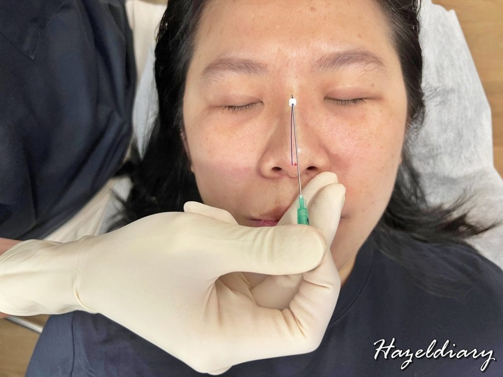 [BEAUTY REVIEW] My Ultra V Hiko Nose Thread Lift Experience with ...